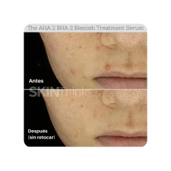 Serum Anti Acné COSRX The AHA 2 BHA 2 Blemish Treatment Serum